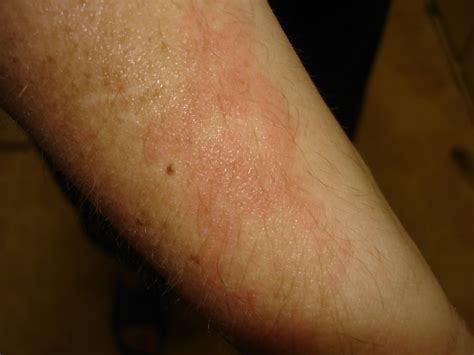 As My Fibro World Turns Red Thick Scaly Rash Photos