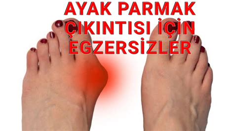 Ayak Parmak Ikintisi Ve Egzers Zler Halluks Valgus Youtube