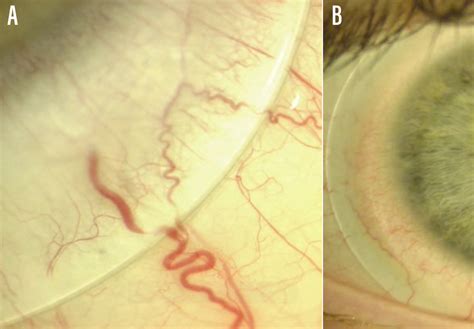 Scleral Lens Complications You Cant Miss Collaborativeeye