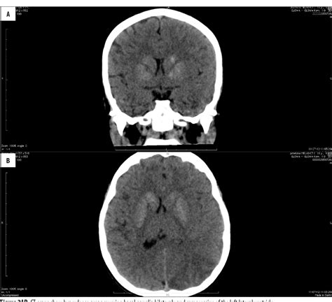 Figure 2 From Ct And Mri Imaging Of The Brain In Melas Syndrome