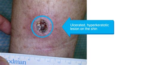 Diagnosis And Management Of Non Melanoma Skin Cancer