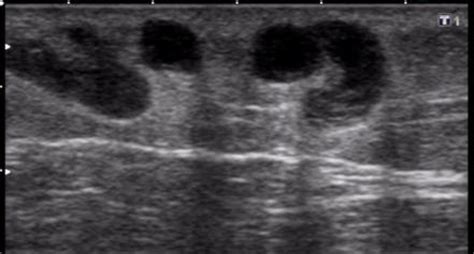 Very few cases have been reported so far. Superficial thrombophlebitis | Image | Radiopaedia.org