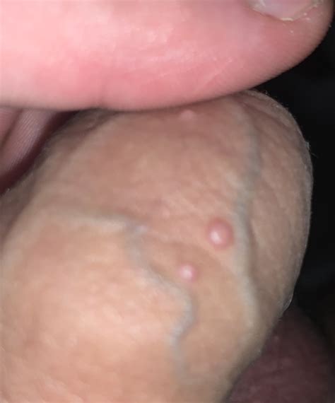 Please Help What Is This Bump On My Penis Sexual Health Forums