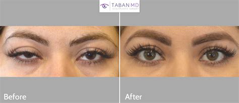 Ptosis Repair And Blepharoplasty Doctorvisit