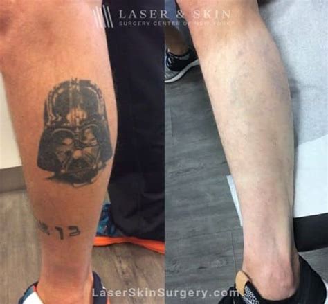 Discover Picosure Tattoo Removal Before And After Latest In Eteachers