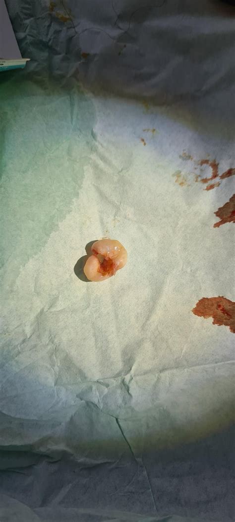 20 Year Old Cyst Popped Doc Put Plastic Piece In To Drain Puss And Now
