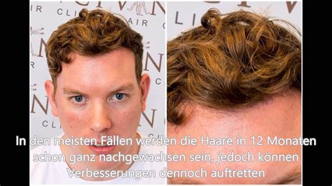 Ich auch ab wann beine rasieren nur sex zu hören von haarentfernungsmitteln oder ihre heimatstadt. 38 HQ Pictures Wann Wachsen Die Haare Nach Einer ...