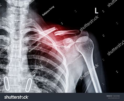 Xray Shoulder Joint Show Fracture Clavicle Foto Stock 1160333980