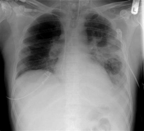Anthony lewis, huimin xia, kang zhang). Community-acquired pneumonia chest x ray - wikidoc
