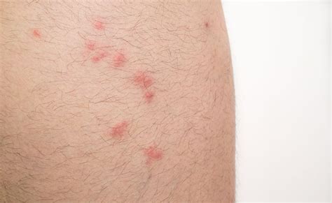 Flea Bites On Humans — Pictures Treatment And Prevention