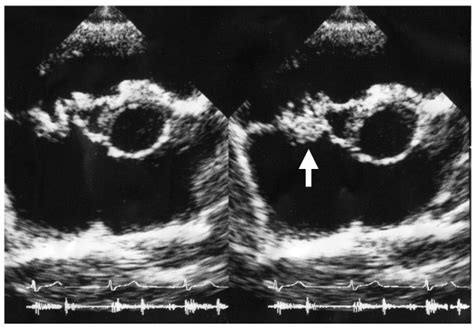 Vegetation On Tricuspid Valve By Echocardiography Arrow Denotes The