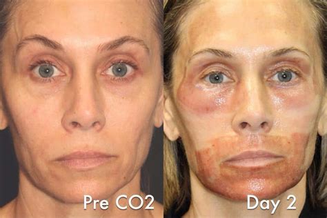 Laser Resurfacing Archives Cosmetic Dermatology Miami Fl