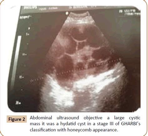 A Huge Primary Hydatid Cyst Of Uterus A Case Report And Review O