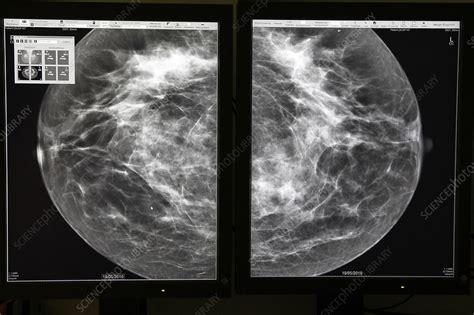 Mammography Result Stock Image C0152205 Science Photo Library