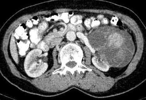 Bosniak Classification System Of Renal Cystic Masses Radiology Reference Article Radiopaedia Org