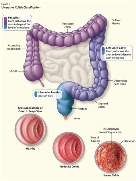 The Latest In Ulcerative Colitis Care An Interactive Supplement On