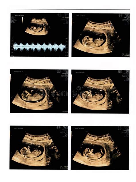 Ultrasound Images Of 13 Weeks Pregnant Show Baby Or Fetus Development