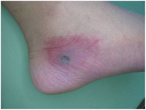 Fusarium Skin Infection
