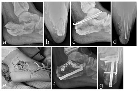 Preoperative A Lateral And B Harris Heel View Radiographs Of A