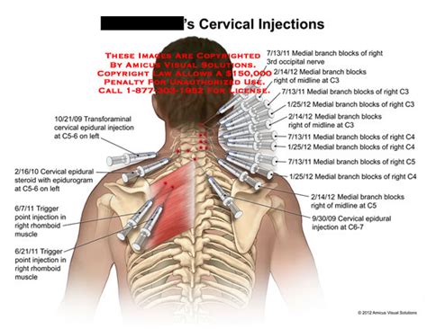 Amicus Illustration Of Amicus Medical Cervical Spine Injections Neck
