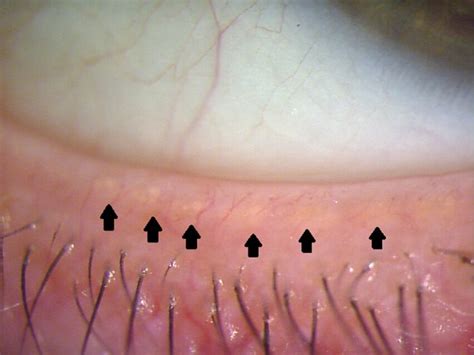 Anatomy Of The Eye Series The Tear Film Lids And Lacrimal Glands My