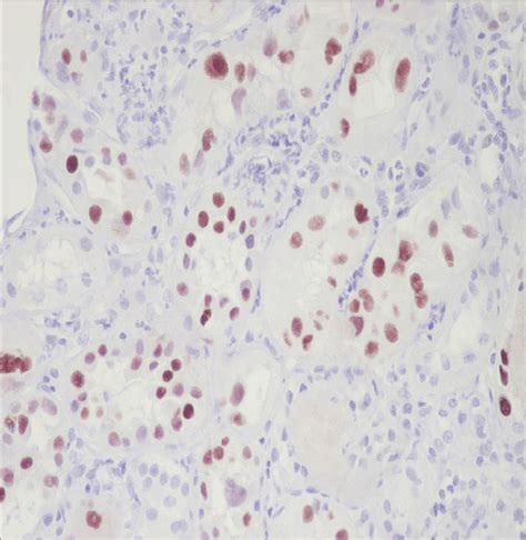 BK virus can also be identified on renal biopsy via SV40 antigen