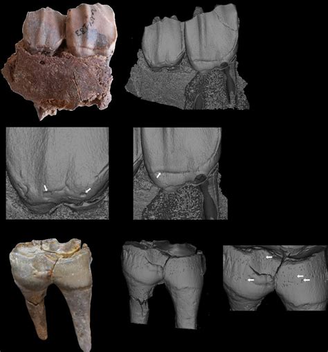 The Three Different Types Of Enamel Hypoplasia Considered In This Study