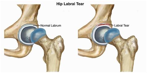 Hip Dislocation A Runners Manual To Treating And Preventing This Injury