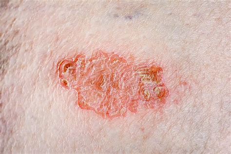 Nummular Eczema Symptoms And Treatment