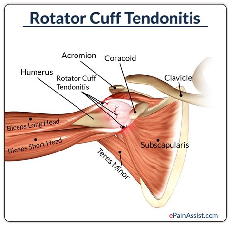 Massage Therapy For Rotator Cuff Tendonitis Rotator Cuff Tendonitis Rotator Cuff Rotator