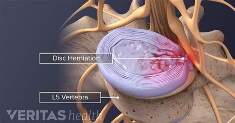 Lumbar Herniated Disc Symptoms