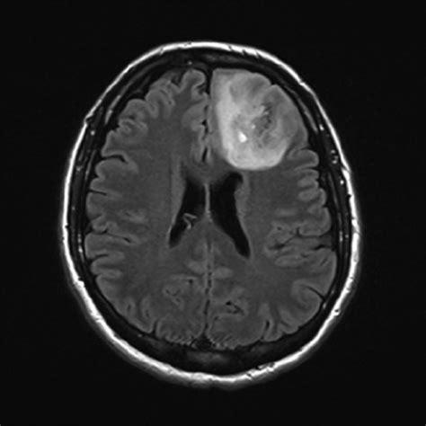 Mass Lesion In Left Frontal Lobe With Abnormal Flair Hyperintensity