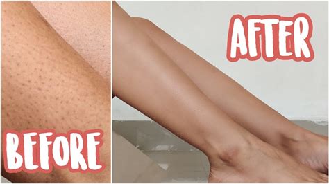 How To Get Rid Of Strawberry Legs Ingrown Hair My Shaving Routine