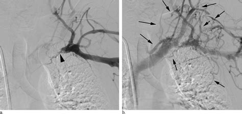 Central Venous Stenosis Is More Often Symptomatic In Hemodialysis