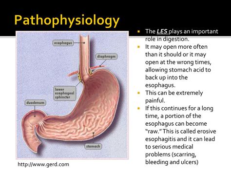 Ppt Benign Peptic Stricture Or Gastro Esophageal Reflux Disease Gerd