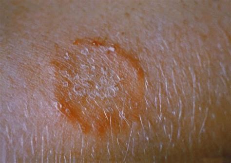Skin Infections And Wrestling Alchetron The Free Social Encyclopedia