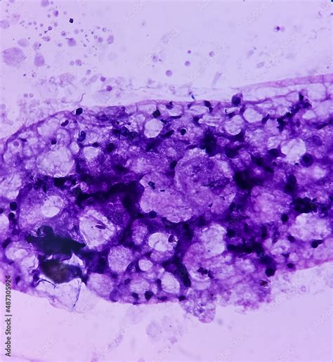 Breast Lumpbiopsy Fat Necrosis Injury Of Fatty Tissue Show