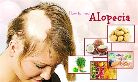 Tips How To Treat Alopecia Fast Naturally In Men And Women