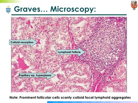 Check spelling or type a new query. Pathology of Thyroid & Endocrine Disorders