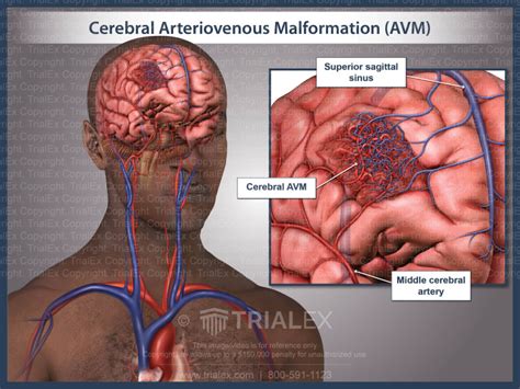 Cerebral Arteriovenous Malformation Avm Trialexhibits Inc