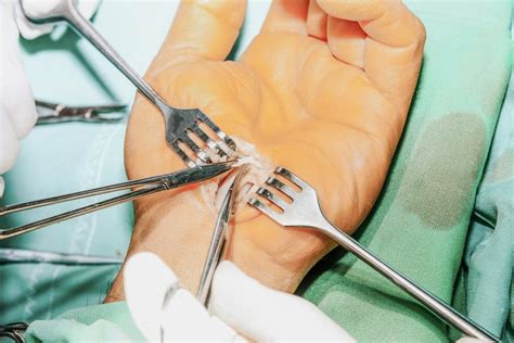 Carpal Tunnel Syndrome Surgery What To Know Before Surgery