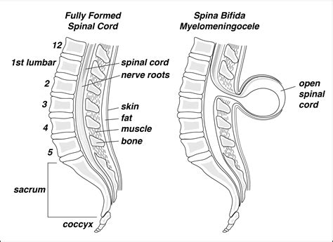 Spina Bifida Treatments Patients And Families Uw Health