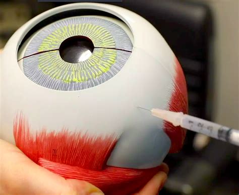 Eye Injections 101 New York Eye Cancer Center
