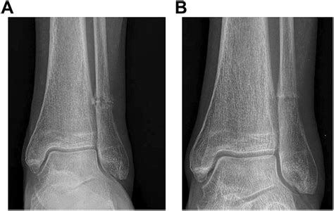 Stress Fractures Of The Foot And Ankle In Athletes Philip B Kaiser
