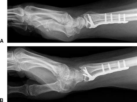 Figure 2 From Lateral Tilt Wrist Radiograph Using The Contralateral