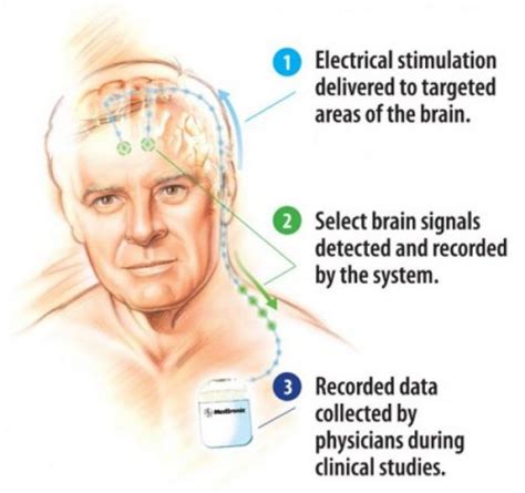 Deep Brain Stimulation Houston Physicians Hospital