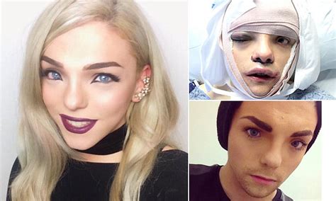 Stunning Transgender Woman Shares Graphic Video Of Her Facial Feminisation Surgery Daily Mail