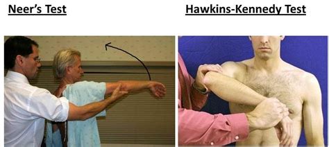 Hawkins Test Shoulder Fingersandfeathersh