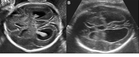 Figure 2 From Neuroimaging Of Ventriculomegaly In The Fetal Period
