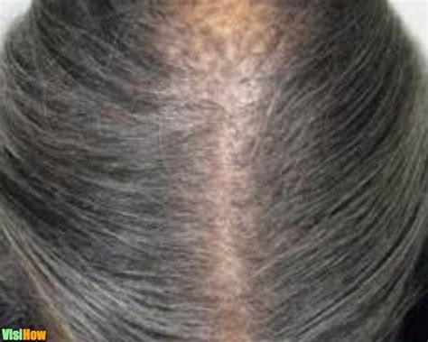 Burning Scalp And Hair Loss Causes